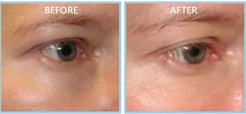 files/Bags-Under-Eyes-with-Fillers.png