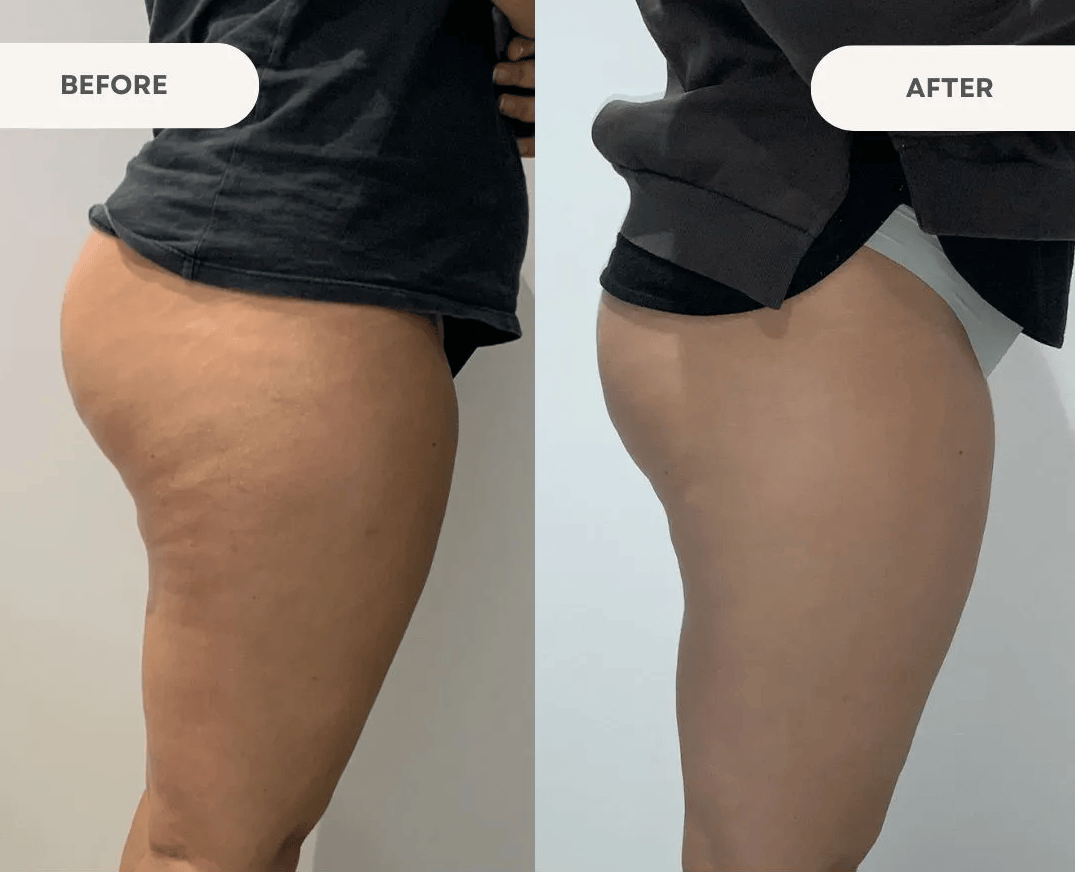 files/Complete-Cellulite-Treatment-3.png