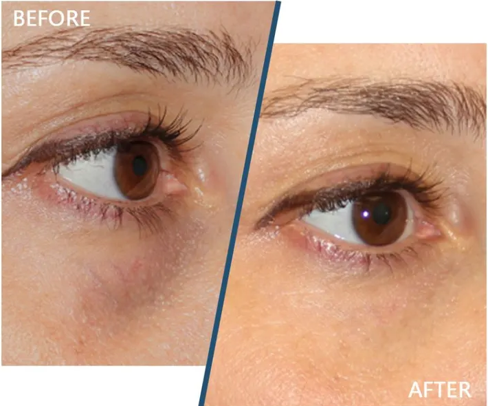 files/before-and-after-under-eye-filler-treatment-for-tear-troughs-hollow-eyes-sunken-eyes-under-eye-bags-1024x835.png